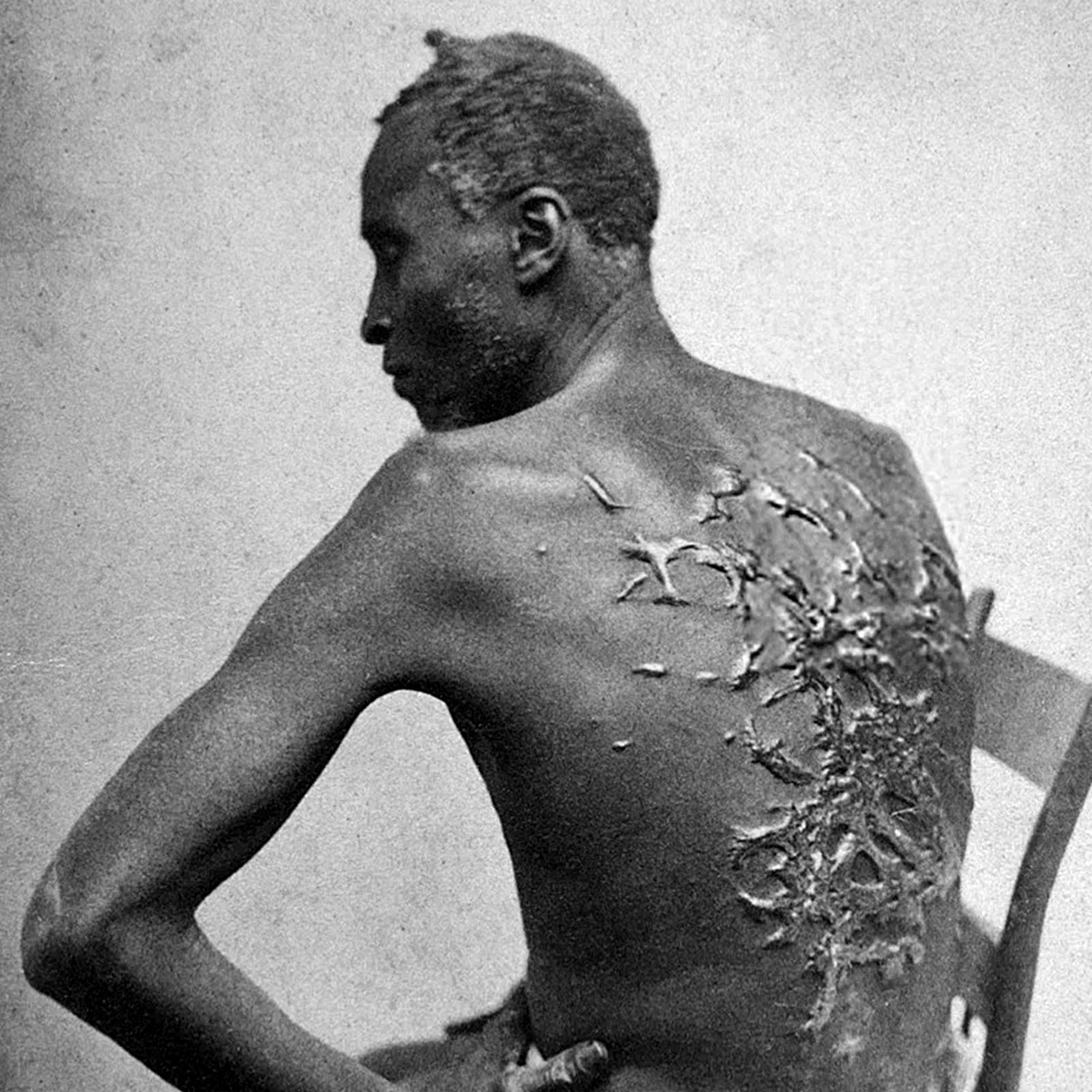 Photograph shows a mass of raised scars on the back of Private Gordon, an enslaved man, left by brutal whippings.